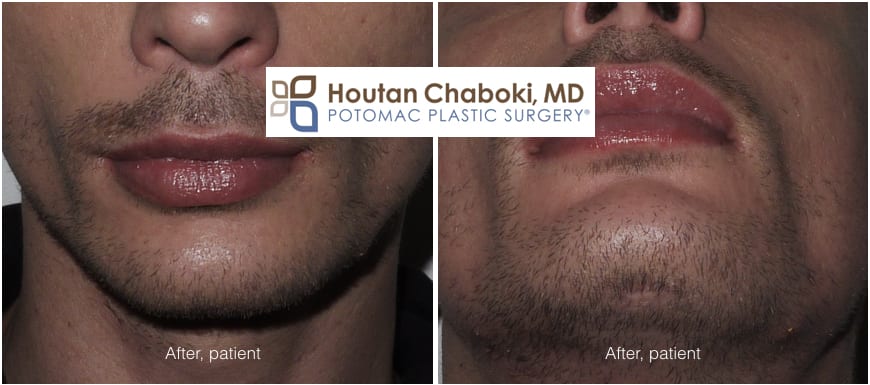 Blog post - before after photos chin augmentation silicone implant scar incision external