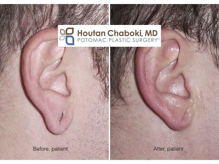 Blog post - before after stretched earlobe repair gauge