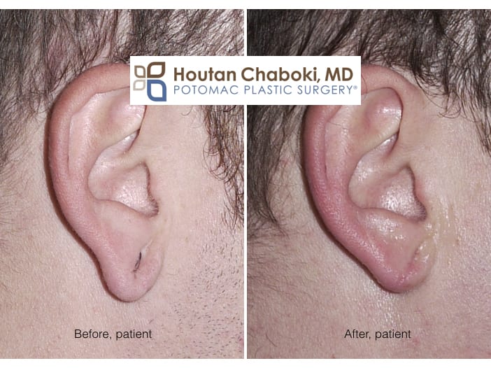 Repairing Gauge or Stretched Earlobes with Plastic Surgery