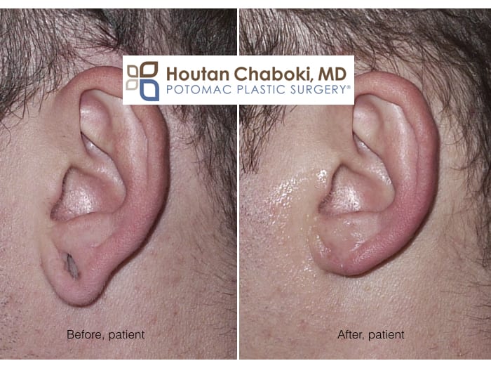 Blog post - before after stretched earlobe repair gauge