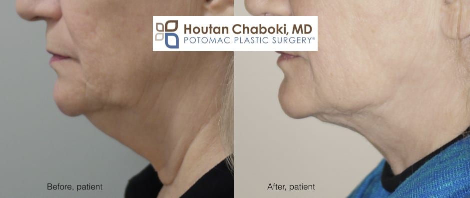 Blog post - before after liposuction neck body skin tightening