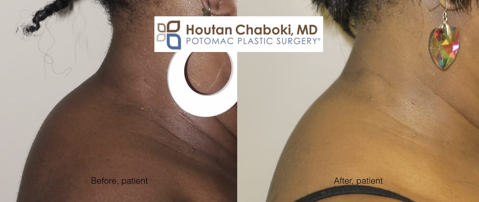 Blog post - before after liposuction neck body skin tightening