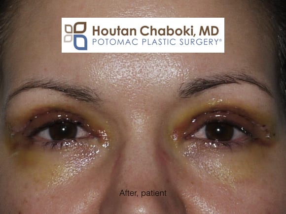 Blog post - before after photo blepharopasty eyelid surgery swelling bruising recovery upper