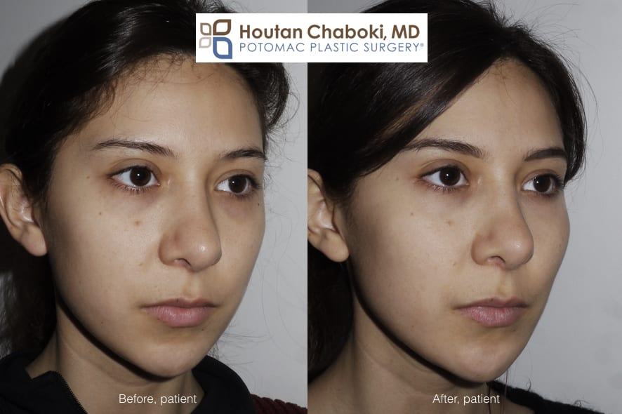 Blog post - before after photos cheek enhancement facial filler Juvederm Restylane