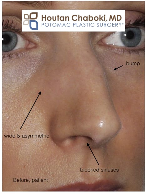 Rhinoplasty Surgery