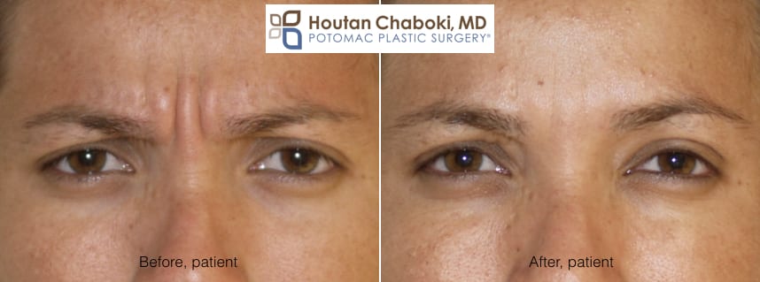 Blog post - before after Botox glabella