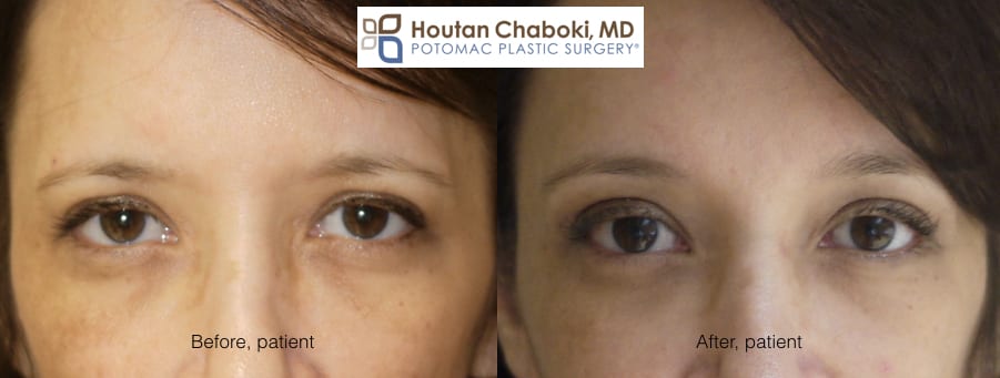 Blog post - before after brow lift photos forhead limited incision endobrow