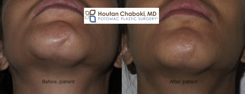 Blog post - before after photos Botox chin mentalis