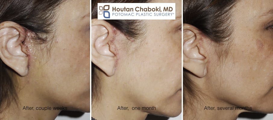 Blog post - before after photos mini lift facelift slift recovery healing swelling