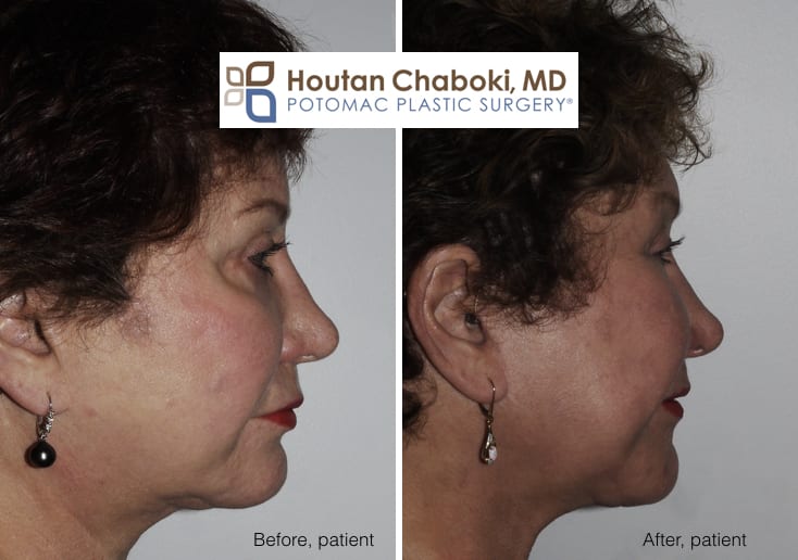 Blog post - before after year facelift neck lift fat transfer cheek