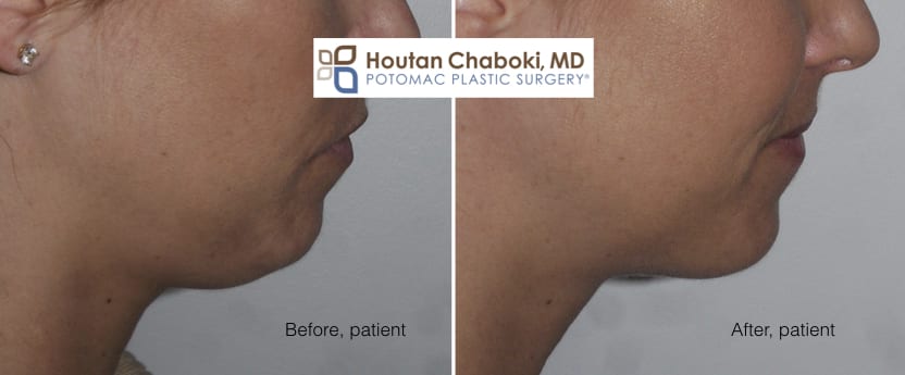Blog post - before after photos chin liposuction double chin neck fat