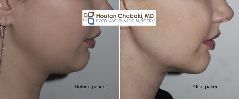 Blog post - before after photos chin liposuction double chin neck fat