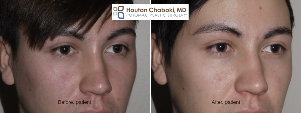 Blog post - before after photos eye bag dark circle facial filler Restylane Juvederm