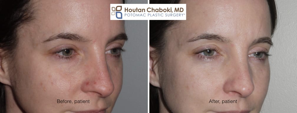 Blog post - before after photos eye bag dark circle facial filler Restylane Juvederm