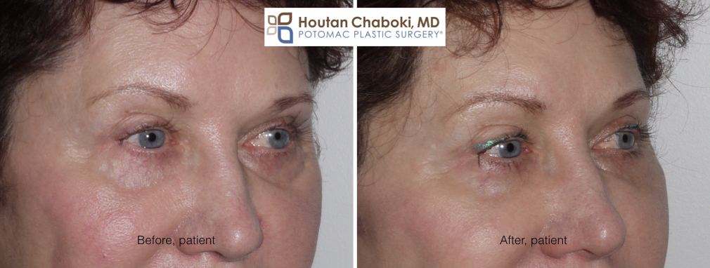 Blog post - before after photos eye bag dark circle facial filler Restylane Juvederm