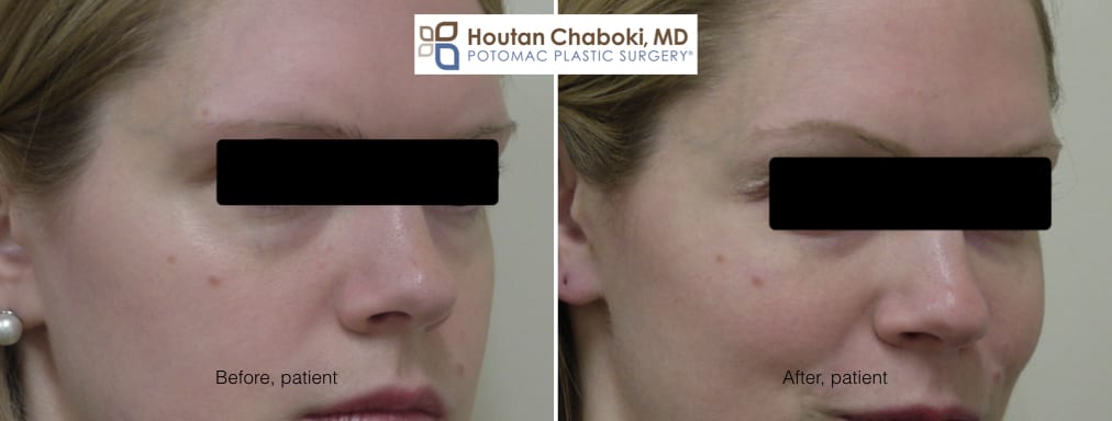 Blog post - before after photos eye bag dark circle facial filler Restylane Juvederm