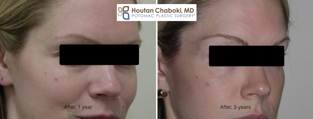 Blog post - before after photos eye bag dark circle facial filler Restylane Juvederm