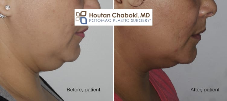 Blog post - photos before after Kybella double chin neck fat