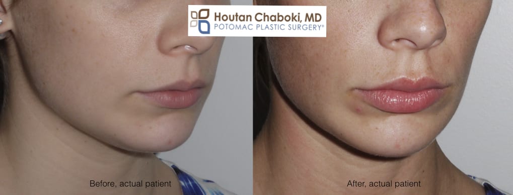 Blog post - before after lip injection photos Juvederm Botox swelling