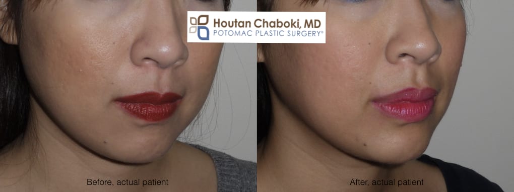 Blog post - before after lip injection photos Juvederm Botox swelling