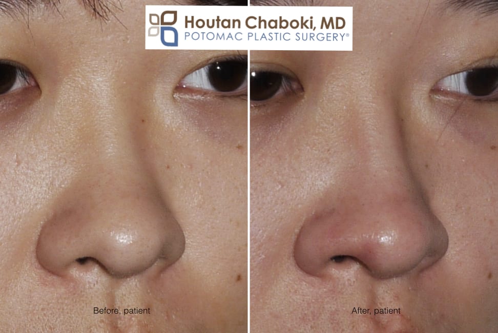 Blog post - before after photos dorsal augmentation build bridge nose cartilage filler