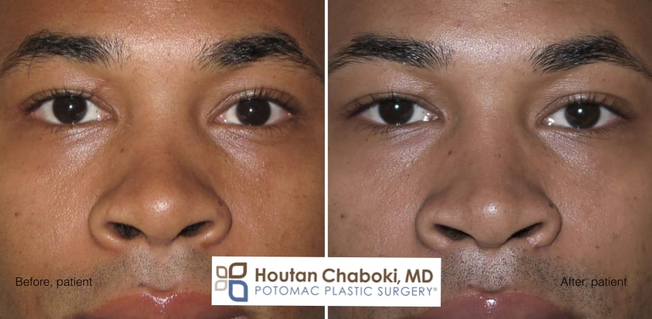 Blog post - before after photos dorsal augmentation build bridge nose cartilage filler