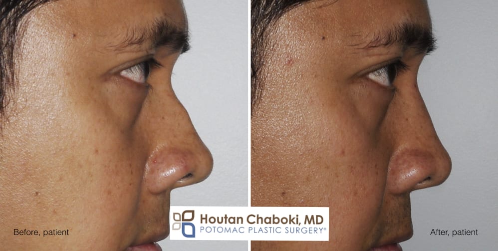 Blog post - before after photos dorsal augmentation build bridge nose cartilage filler