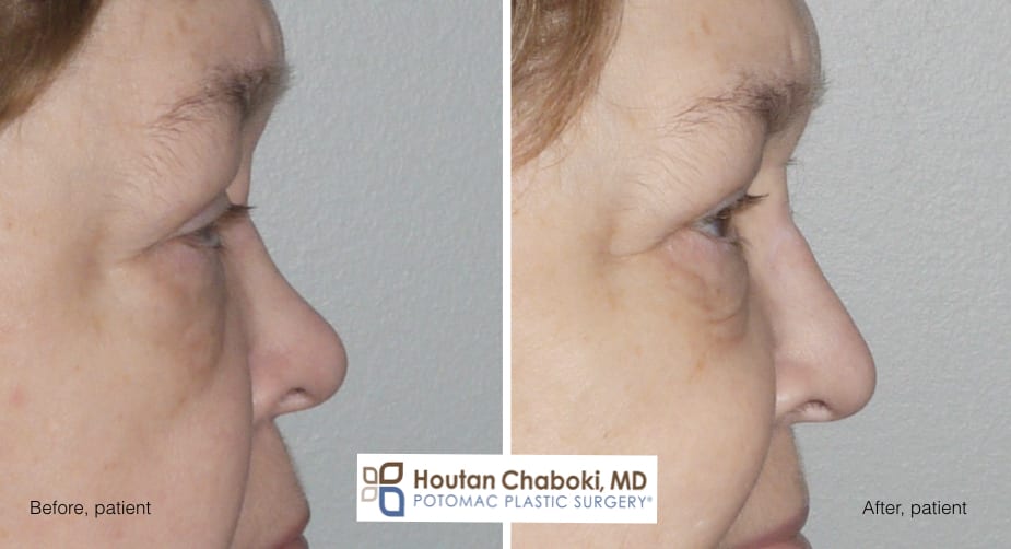 Blog post - before after photos dorsal augmentation build bridge nose cartilage filler