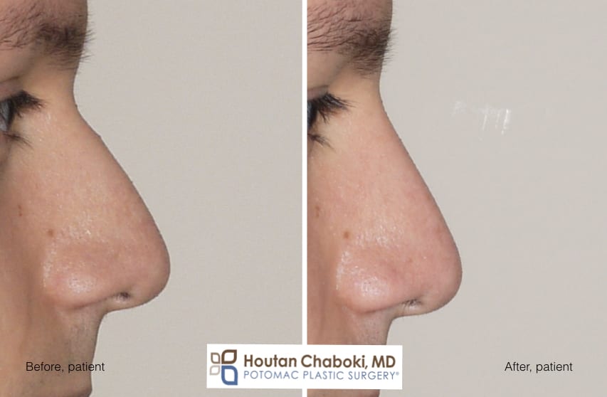 Blog post - before after photos dorsal augmentation build bridge nose cartilage filler
