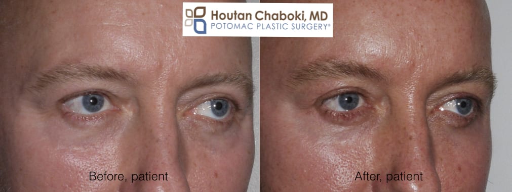 Blog post - photos before after facial plastc surgery men eyes brow eyelid neck chin facelift liposuction