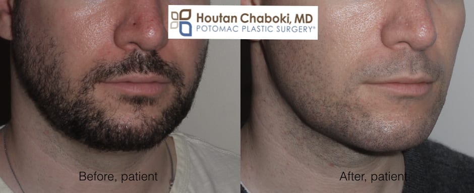 Blog post - photos before after facial plastc surgery men eyes brow eyelid neck chin facelift liposuction