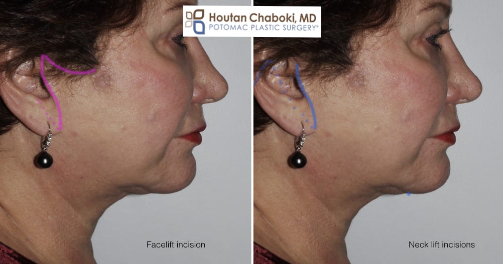 Blog post - photos facelift neck lift candidate plastic surgery
