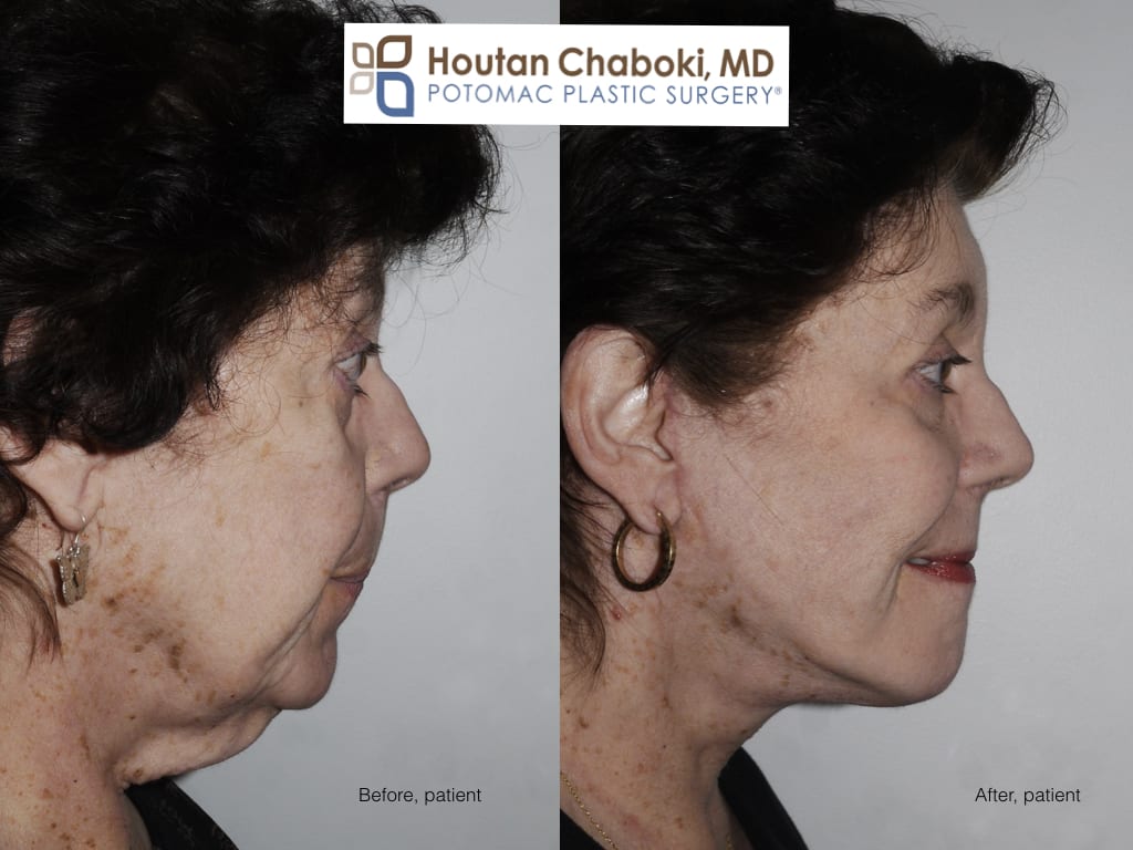 Blog post - photos facelift neck lift candidate plastic surgery