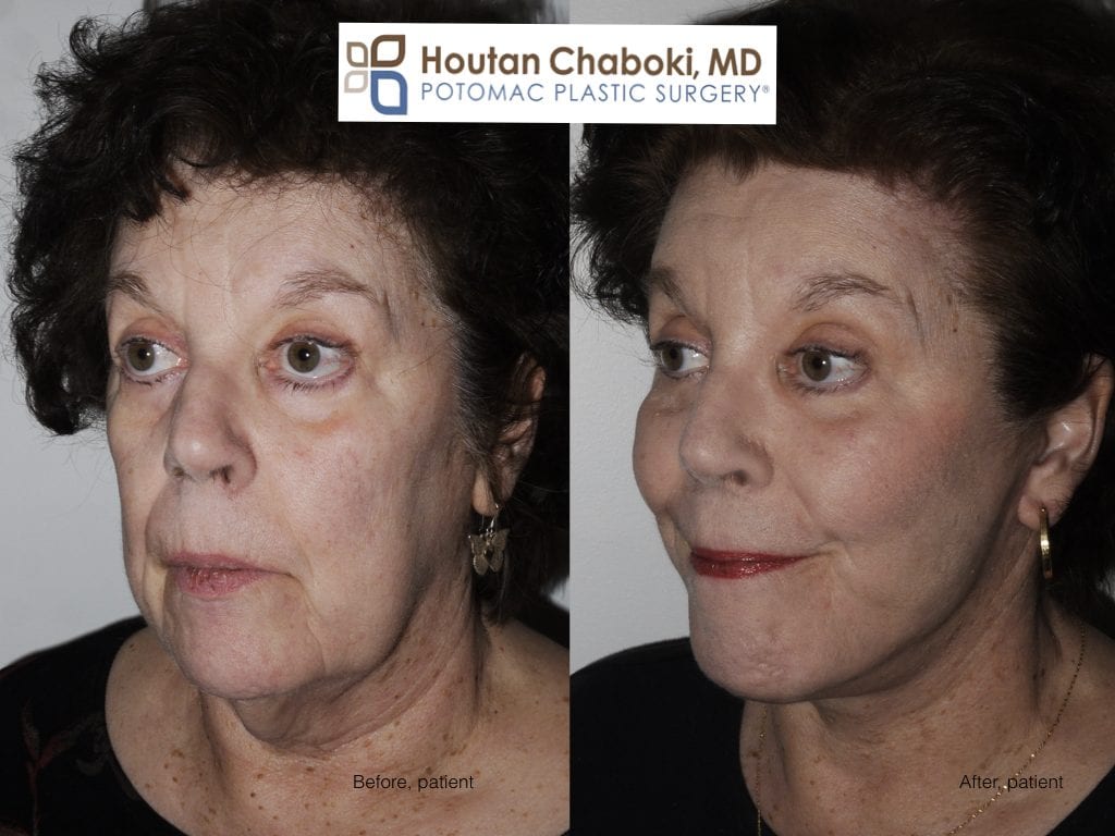 Blog post - photos facelift neck lift candidate plastic surgery