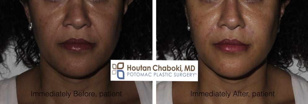 Blog post - before after Belotero photos nonsurgical smile lines lips injection cheek
