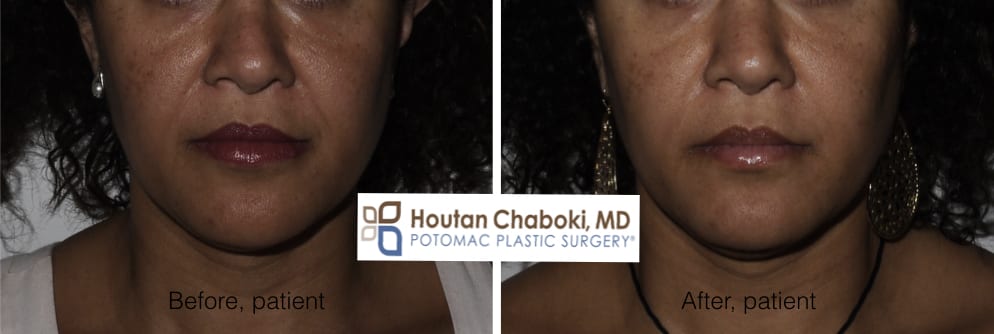 Blog post - before after Belotero photos nonsurgical smile lines lips injection cheek