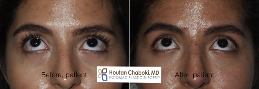 Blog post - before after millenial nonsurgical face eye filler botox