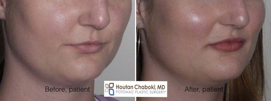 Blog post - before after millenial nonsurgical face eye filler botox