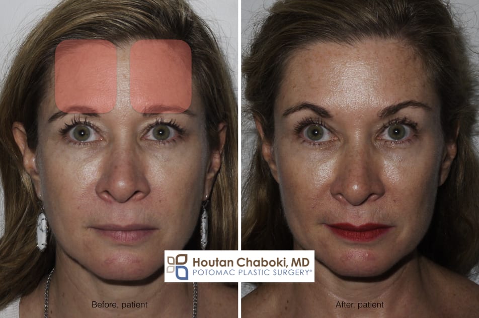 Blog post - before after photo brow lift forehead Botox frontalis muscle