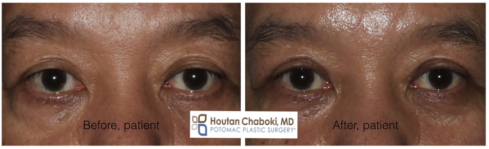 Blog post - photos before after revision eyelid surgery Asian blepharoplasty