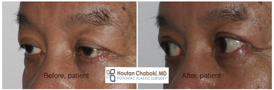 Blog post - photos before after revision eyelid surgery Asian blepharoplasty