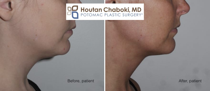 Blog post - photos before after chin surgery women neck lift facelift liposuction augmentation jawline