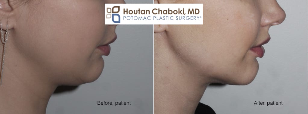 Blog post - photos before after chin surgery women neck lift facelift liposuction augmentation jawline