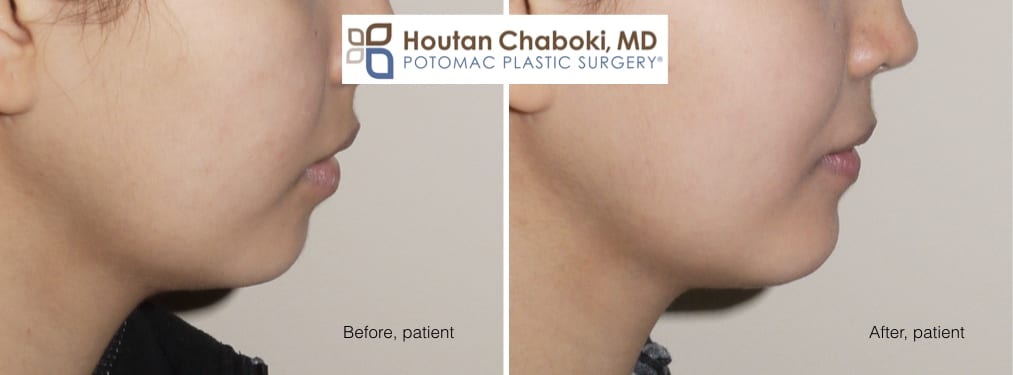 Blog post - photos before after chin surgery women neck lift facelift liposuction augmentation jawline