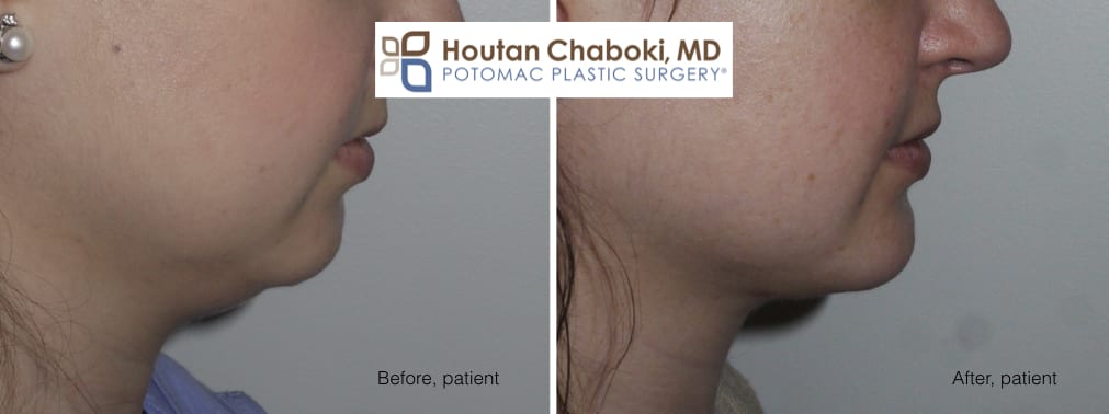 Blog post - photos before after chin surgery women neck lift facelift liposuction augmentation jawline