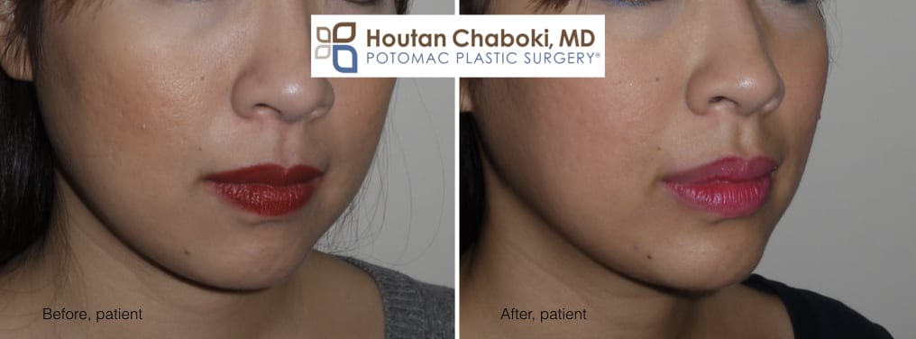 Blog post - photos before after chin surgery women neck lift facelift liposuction augmentation jawline