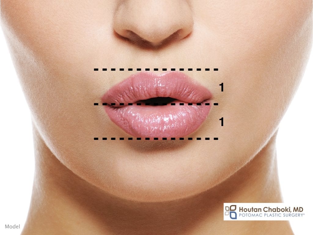 Blog - lip enhancement injection facial filler ideal lip shape attractive