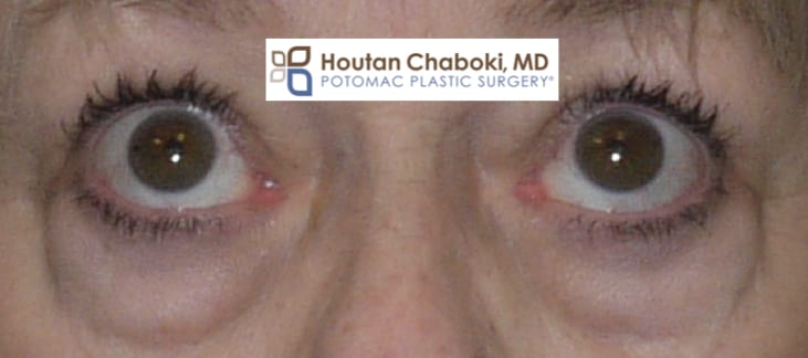 Blog post - photos thyroid eye bag blepharoplasty orbital decompression.001