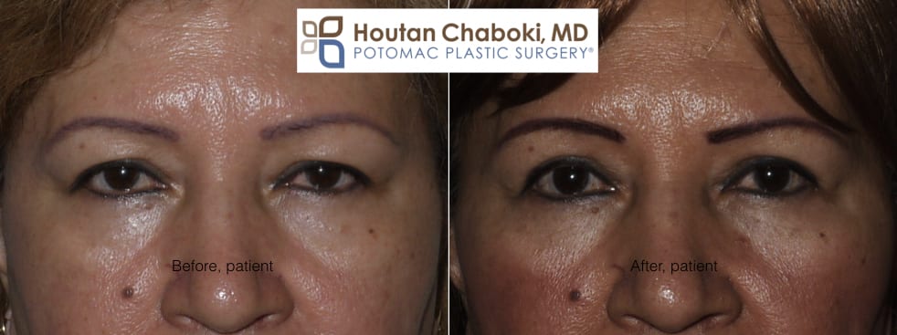 Blog post - before after photos upper eyelid surgery blepharoplasty wrinkles Asian double skin