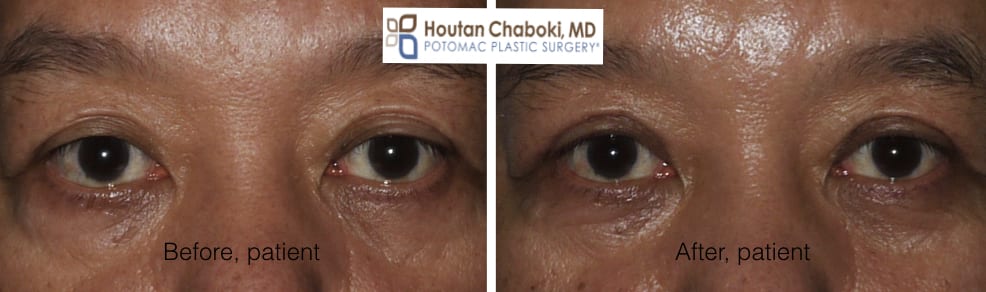 Blog post - before after photos upper eyelid surgery blepharoplasty wrinkles Asian double skin